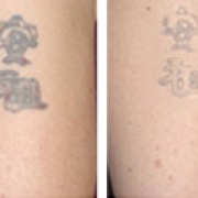 Odstranění tetování 3